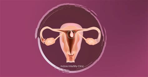 varice uterine pe care le tratează medicul